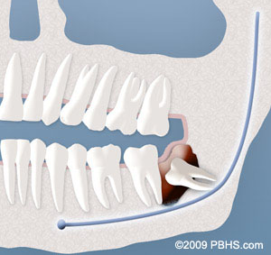 cyst formation