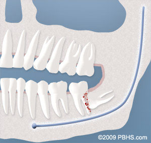damage to adjacent teeth