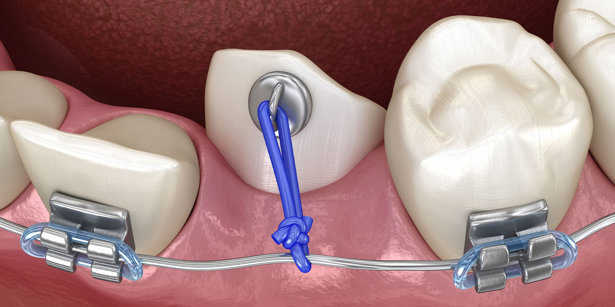 impacted canine teeth bracket to braces