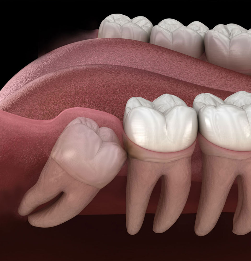 wisdom tooth pertruding