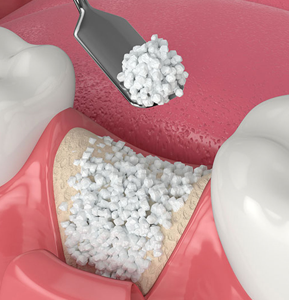 bone graft 3d