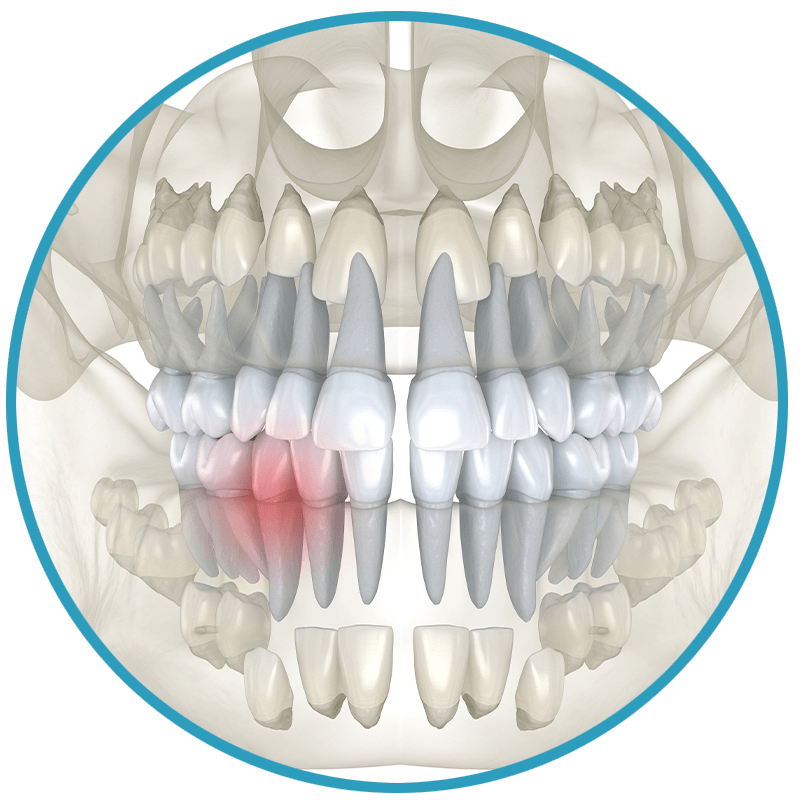 impacted canine