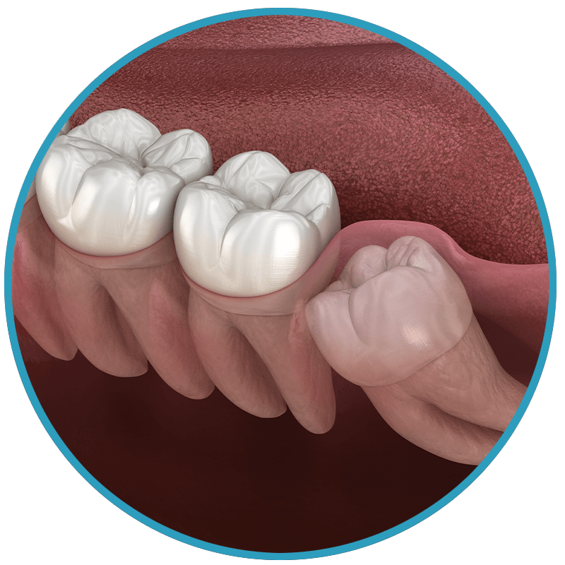 partial eruption wisdom teeth