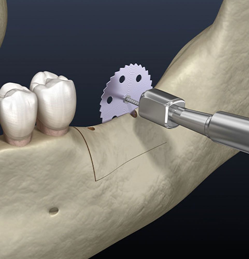 ridge augmentation 3d