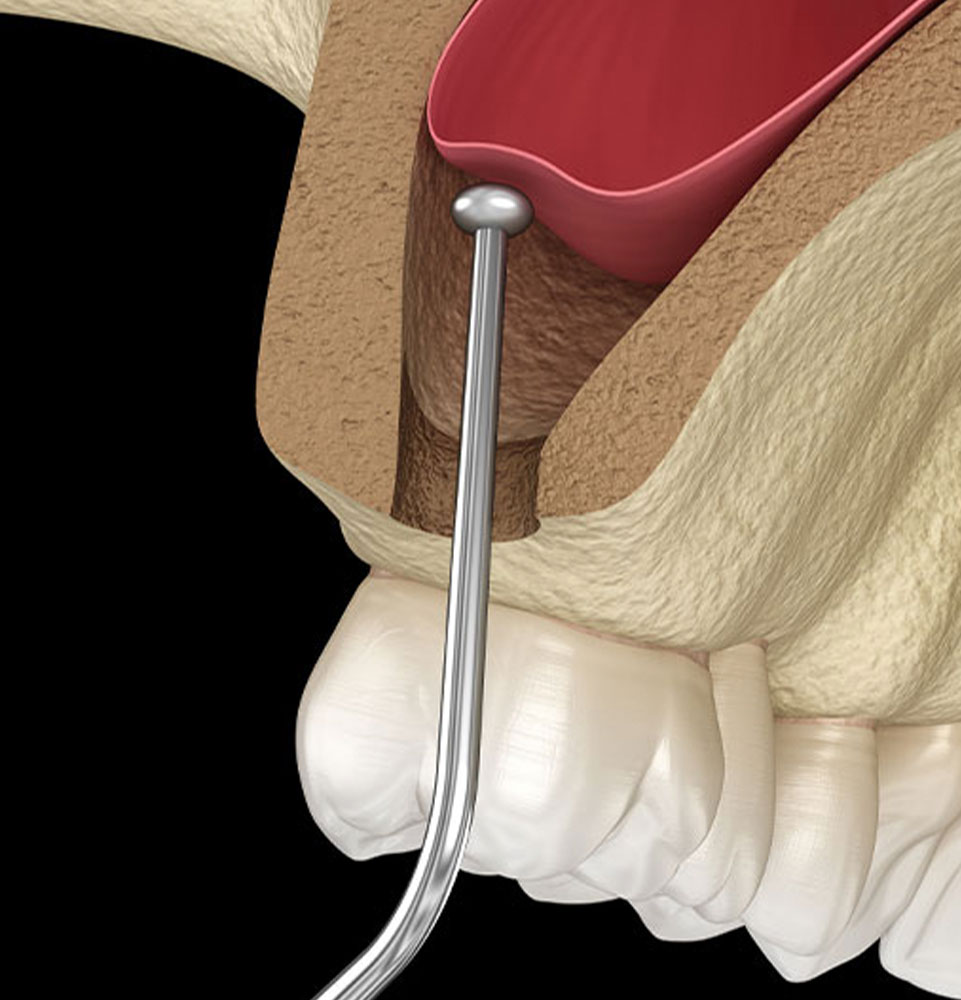 sinus lift 3d