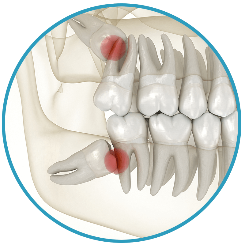 wisdom tooth no room erupt