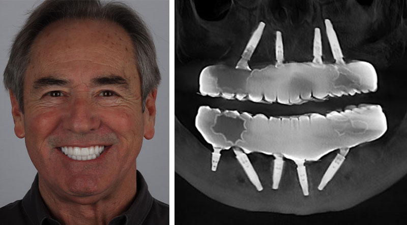 tony mario post after full arch